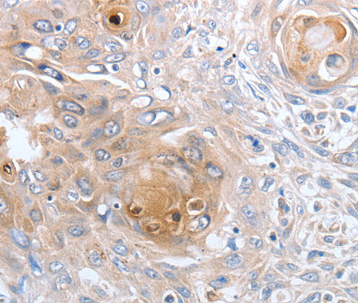 Immunohistochemistry of paraffin-embedded Human esophagus cancer tissue using CASP12 Polyclonal Antibody at dilution 1:50