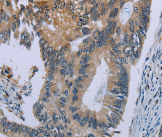 Immunohistochemistry of paraffin-embedded Human colon cancer using CEBPD Polyclonal Antibody at dilution of 1:40