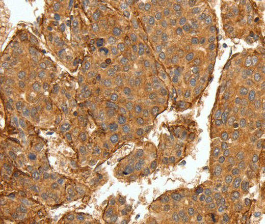 Immunohistochemistry of paraffin-embedded Human lung cancer tissue using COL4A1 Polyclonal Antibody at dilution 1:30