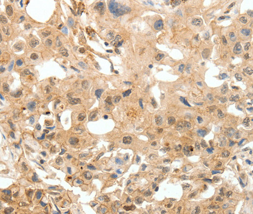 Immunohistochemistry of paraffin-embedded Human breast cancer tissue using COL4A1 Polyclonal Antibody at dilution 1:30