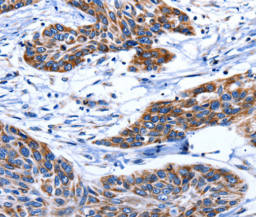 Immunohistochemistry of paraffin-embedded Human esophagus cancer tissue using AQP8 Polyclonal Antibody at dilution 1:75