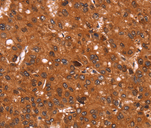 Immunohistochemistry of paraffin-embedded Human liver cancer tissue using Cyclin D3 Polyclonal Antibody at dilution 1:40