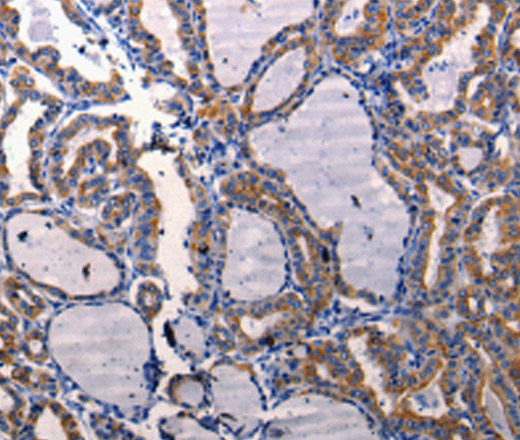 Immunohistochemistry of paraffin-embedded Human thyroid cancer using DRD1 Polyclonal Antibody at dilution of 1:50