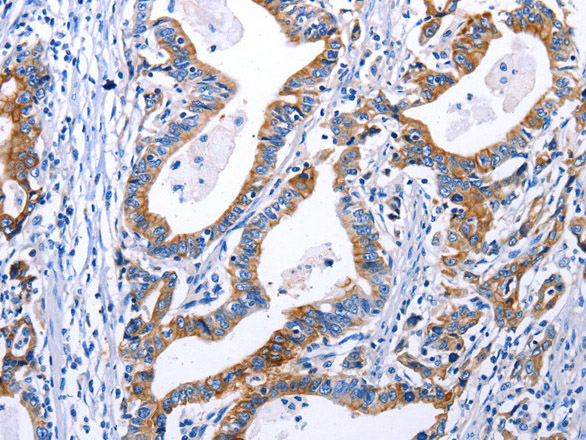 Immunohistochemistry of paraffin-embedded Human gastric cancer using DRD4 Polyclonal Antibody at dilution of 1:30