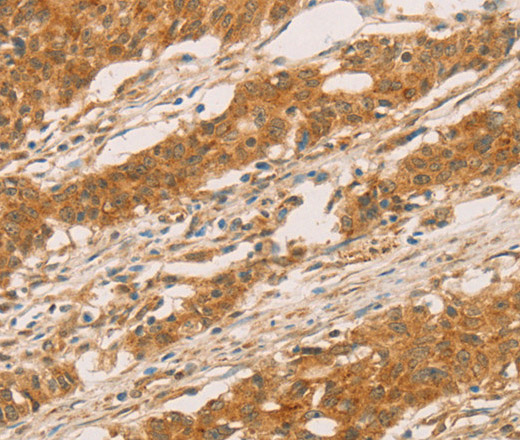 Immunohistochemistry of paraffin-embedded Human gastric cancer tissue using SLC6A3 Polyclonal Antibody at dilution 1:50