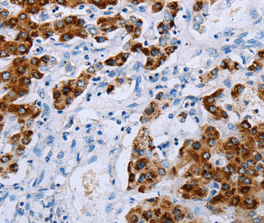 Immunohistochemistry of paraffin-embedded Human liver cancer tissue using NDUFA12 Polyclonal Antibody at dilution 1:50