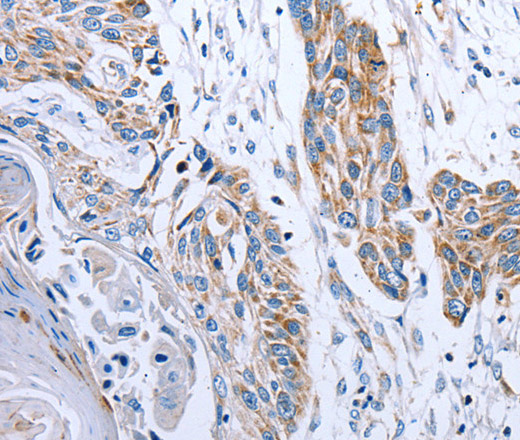 Immunohistochemistry of paraffin-embedded Human esophagus cancer tissue using NDUFA12 Polyclonal Antibody at dilution 1:50