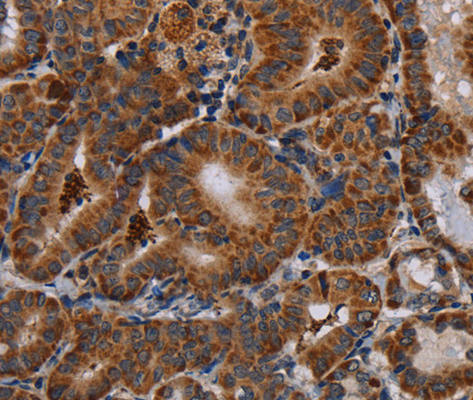 Immunohistochemistry of paraffin-embedded Human thyroid cancer tissue using DISC1 Polyclonal Antibody at dilution 1:30