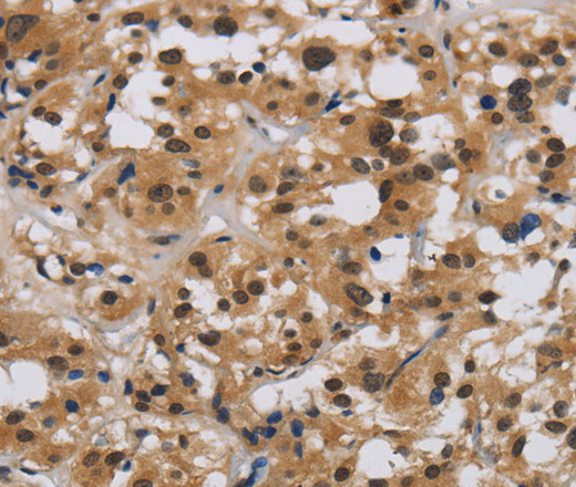 Immunohistochemistry of paraffin-embedded Human thyroid cancer tissue using E2F4 Polyclonal Antibody at dilution 1:40