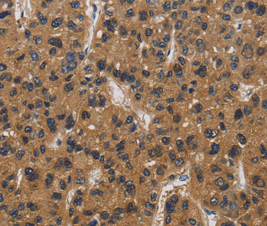 Immunohistochemistry of paraffin-embedded Human liver cancer tissue using E2F4 Polyclonal Antibody at dilution 1:40
