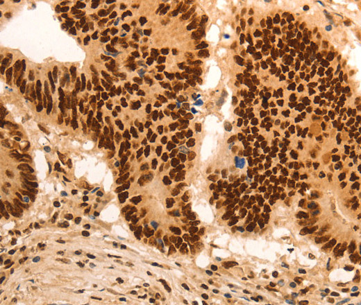 Immunohistochemistry of paraffin-embedded Human colon cancer tissue using E2F7 Polyclonal Antibody at dilution 1:60