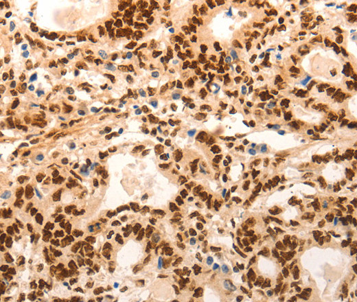 Immunohistochemistry of paraffin-embedded Human gasrtic cancer tissue using E2F7 Polyclonal Antibody at dilution 1:60