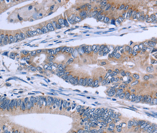 Immunohistochemistry of paraffin-embedded Human colon cancer using SLC1A6 Polyclonal Antibody at dilution of 1:40