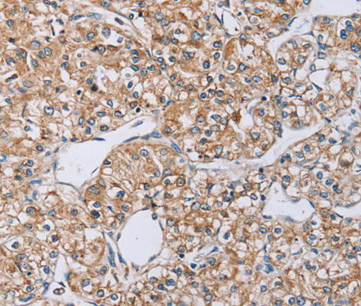 Immunohistochemistry of paraffin-embedded Human prostate cancer using EDA Polyclonal Antibody at dilution of 1:40