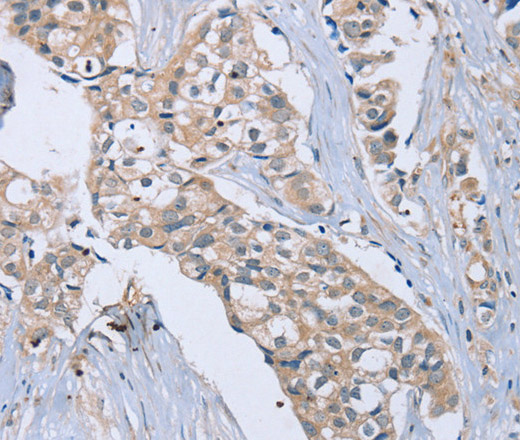 Immunohistochemistry of paraffin-embedded Human breast cancer using EDA Polyclonal Antibody at dilution of 1:40