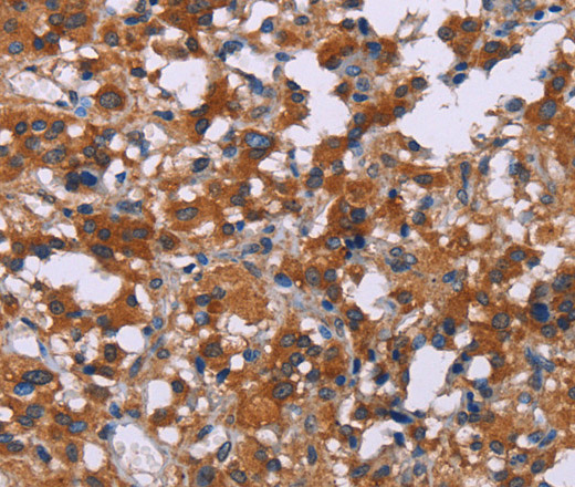 Immunohistochemistry of paraffin-embedded Human thyroid cancer using ERK1/2 Polyclonal Antibody at dilution of 1:30