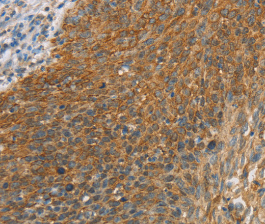 Immunohistochemistry of paraffin-embedded Human cervical cancer tissue using ERK 3 Polyclonal Antibody at dilution 1:40
