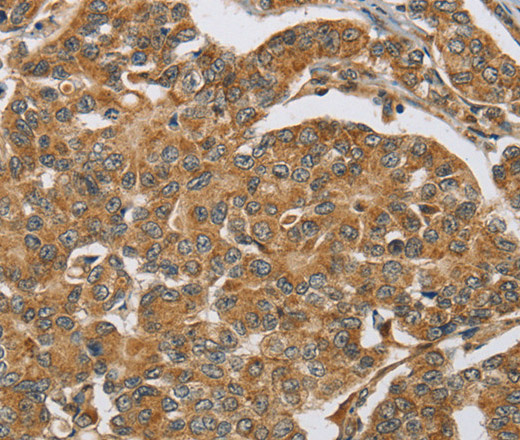 Immunohistochemistry of paraffin-embedded Human breast cancer tissue using ERK 3 Polyclonal Antibody at dilution 1:40