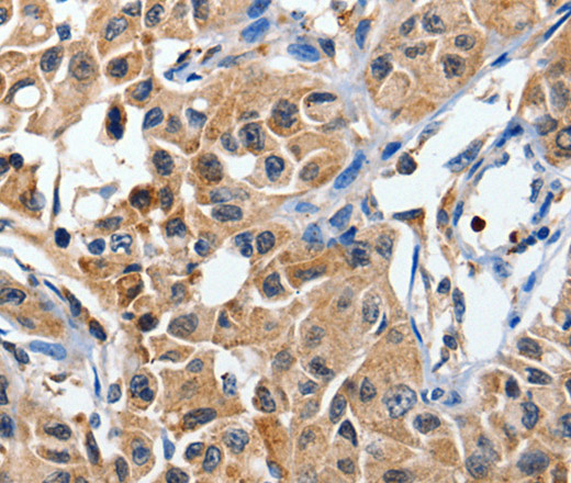 Immunohistochemistry of paraffin-embedded Human lung cancer tissue using DUSP8 Polyclonal Antibody at dilution 1:40