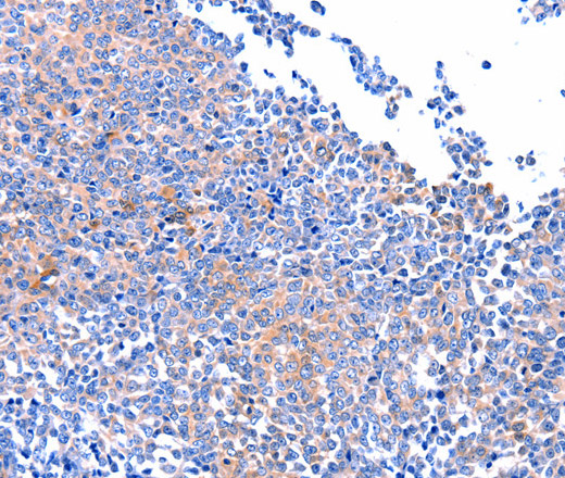 Immunohistochemistry of paraffin-embedded Human ovarian cancer using FAK Polyclonal Antibody at dilution of 1:75