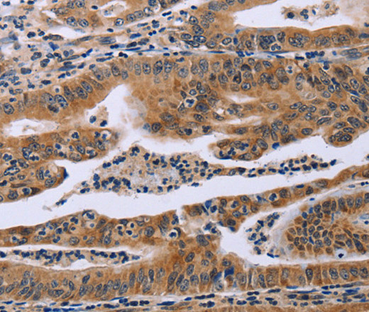 Immunohistochemistry of paraffin-embedded Human gasrtic cancer tissue using FAF1 Polyclonal Antibody at dilution 1:40