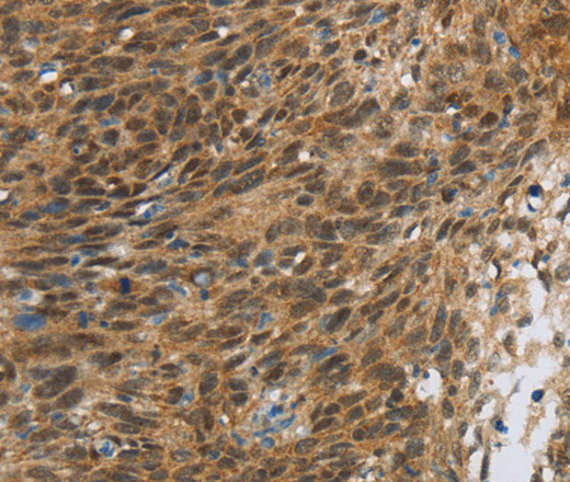 Immunohistochemistry of paraffin-embedded Human cervical cancer tissue using FOXB1 Polyclonal Antibody at dilution 1:30