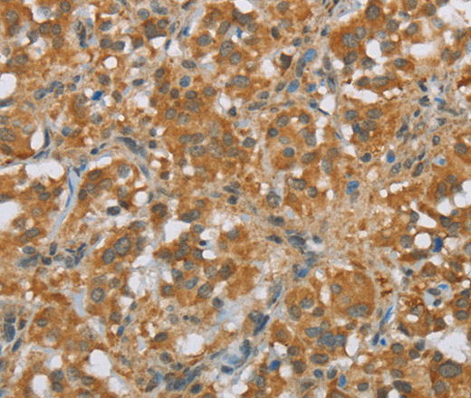 Immunohistochemistry of paraffin-embedded Human thyroid cancer tissue using FOXB1 Polyclonal Antibody at dilution 1:30