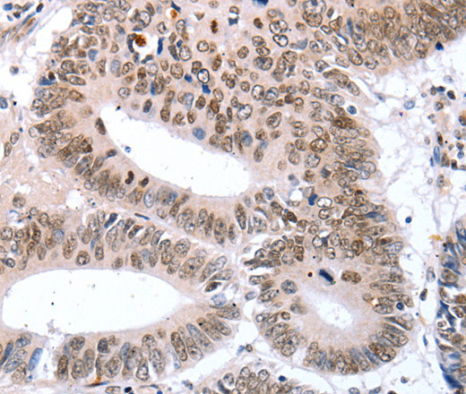 Immunohistochemistry of paraffin-embedded Human colon cancer tissue using TBX2 Polyclonal Antibody at dilution 1:32