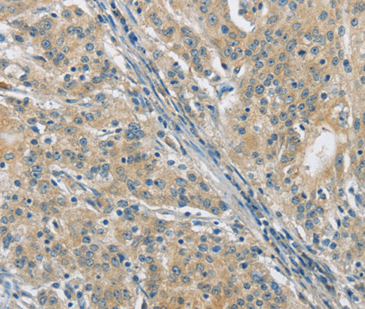 Immunohistochemistry of paraffin-embedded Human gasrtic cancer tissue using PKD1 Polyclonal Antibody at dilution 1:40