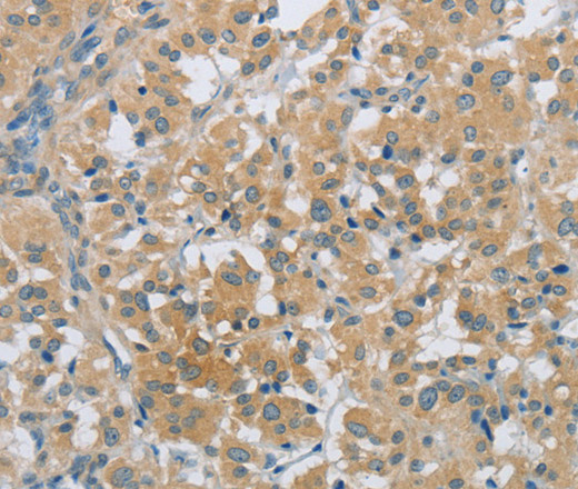 Immunohistochemistry of paraffin-embedded Human thyroid cancer tissue using PKD1 Polyclonal Antibody at dilution 1:40