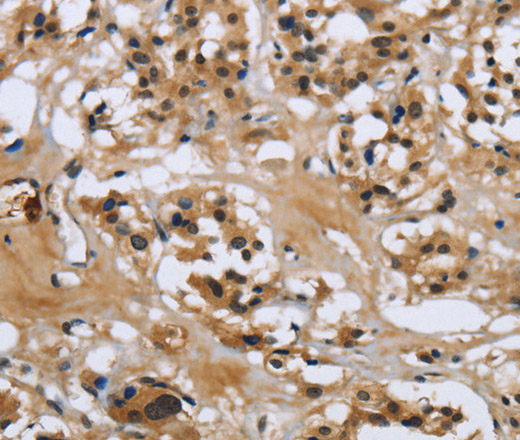 Immunohistochemistry of paraffin-embedded Human thyroid cancer tissue using LGALS7 Polyclonal Antibody at dilution 1:50