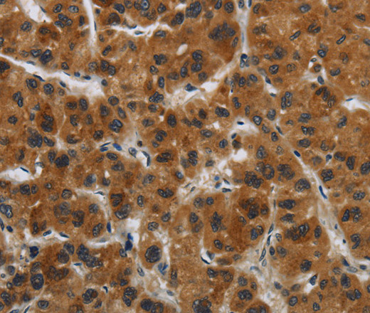 Immunohistochemistry of paraffin-embedded Human liver cancer tissue using GATA5 Polyclonal Antibody at dilution 1:50