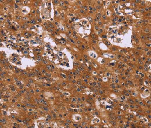 Immunohistochemistry of paraffin-embedded Human gastic cancer using CMTM6 Polyclonal Antibody at dilution of 1:40