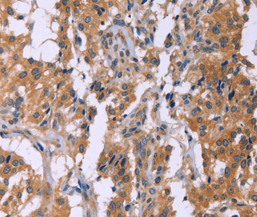 Immunohistochemistry of paraffin-embedded Human thyroid cancer using CMTM6 Polyclonal Antibody at dilution of 1:40