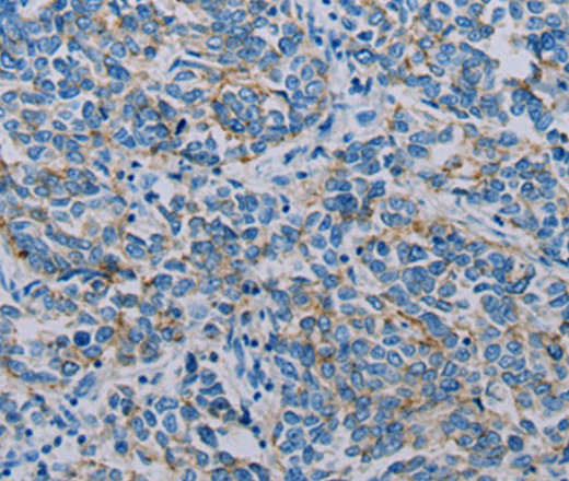 Immunohistochemistry of paraffin-embedded Human breast cancer using Claudin 4 Polyclonal Antibody at dilution of 1:35