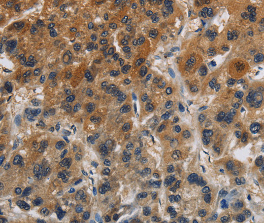 Immunohistochemistry of paraffin-embedded Human liver cancer tissue using Claudin 8 Polyclonal Antibody at dilution 1:50