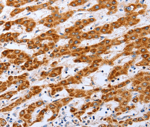 Immunohistochemistry of paraffin-embedded Human liver cancer tissue using Claudin 10 Polyclonal Antibody at dilution 1:50