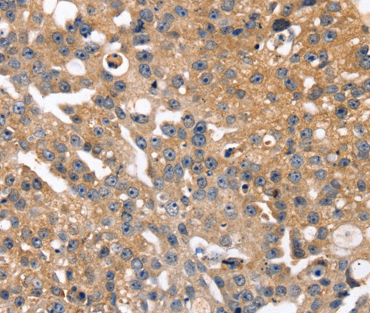 Immunohistochemistry of paraffin-embedded Human breast cancer tissue using SLC2A2 Polyclonal Antibody at dilution 1:35