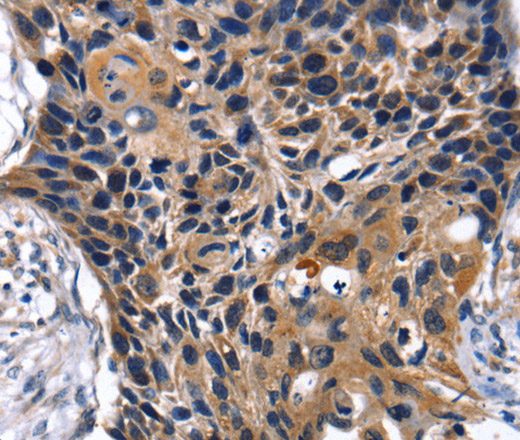 Immunohistochemistry of paraffin-embedded Human esophagus cancer tissue using SLC2A2 Polyclonal Antibody at dilution 1:35