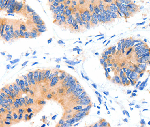 Immunohistochemistry of paraffin-embedded Human colon cancer tissue using GLUT-4 Polyclonal Antibody at dilution 1:70
