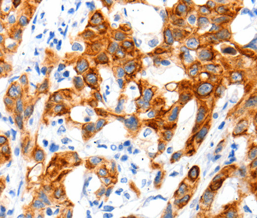 Immunohistochemistry of paraffin-embedded Human lung cancer tissue using SLC2A11 Polyclonal Antibody at dilution 1:140