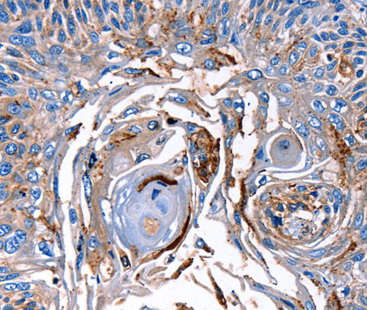 Immunohistochemistry of paraffin-embedded Human esophagus cancer tissue using LRP2  Polyclonal Antibody at dilution 1:40