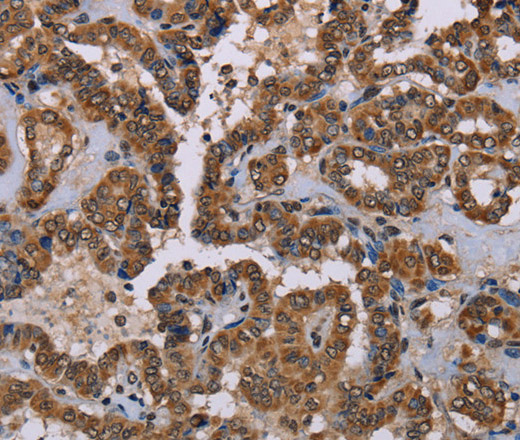 Immunohistochemistry of paraffin-embedded Human thyroid cancer tissue using GRK1 Polyclonal Antibody at dilution 1:40