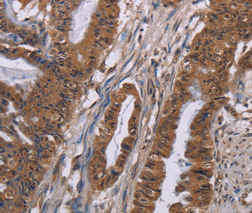 Immunohistochemistry of paraffin-embedded Human esophagus cancer tissue using GRK1 Polyclonal Antibody at dilution 1:40