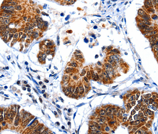 Immunohistochemistry of paraffin-embedded Human colon cancer tissue using GSK3 alpha Polyclonal Antibody at dilution 1:50