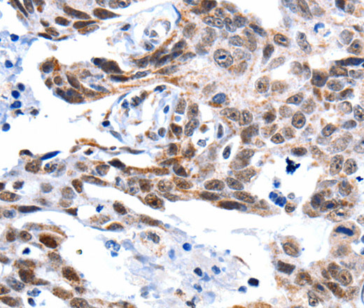 Immunohistochemistry of paraffin-embedded Human ovarian cancer tissue using GSK3 alpha Polyclonal Antibody at dilution 1:50