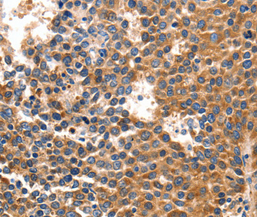 Immunohistochemistry of paraffin-embedded Human liver cancer using IRF1 Polyclonal Antibody at dilution of 1:40