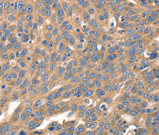 Immunohistochemistry of paraffin-embedded Human ovarian cancer using IRF1 Polyclonal Antibody at dilution of 1:40