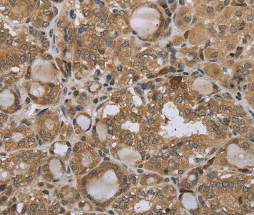 Immunohistochemistry of paraffin-embedded Human thyroid cancer tissue using STMN2/3/4 Polyclonal Antibody at dilution 1:45