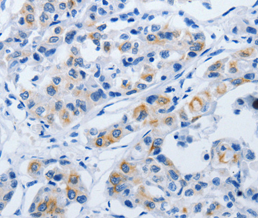 Immunohistochemistry of paraffin-embedded Human lung cancer using BPIFB3 Polyclonal Antibody at dilution of 1:50